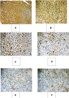 Prevalence and Prognostic Implications of PD-L1 Expression in Soft Tissue Sarcomas